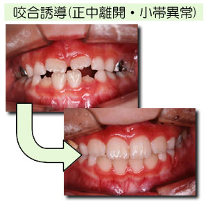 正しいかみ合わせの育成