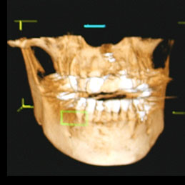 歯科用ＣＴ