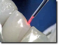 レーザーによる虫歯治療